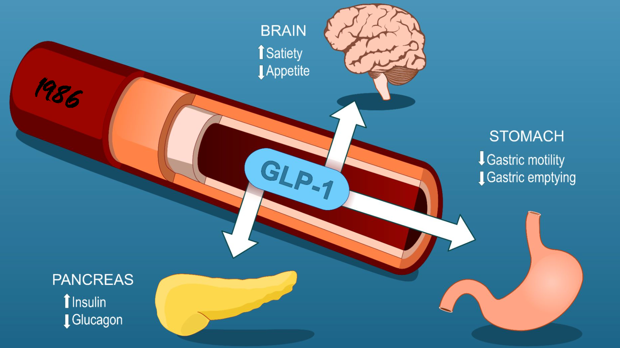 GLP-1受体激动剂：肥胖、代谢综合征与前列腺癌的交互作用及治疗潜