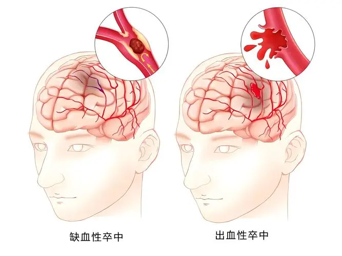 脑中风康复期，安宫牛黄丸真是“神助攻”？科学康复才是关键